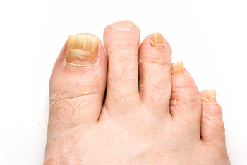 laser treatment for toenail fungus