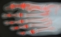 Early Signs of Arthritis in the Feet Should Not Be Overlooked