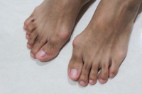 Non-operative Management of Bunions Can Offer Relief