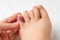 Causes and Symptoms of Broken Toes