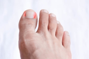 Causes and Symptoms of Ingrown Toenails